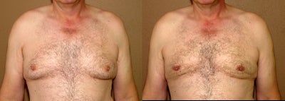 gynecomastia correction - 
	gynecomastia correction with ultrasonic, laser liposction and excision
