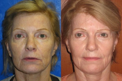 Total FX Laser (active and Deep FX) - 
	She particularly is concerned about deep intersecting rhytids around mouth,dyschromia of the face and wrinkled face,
