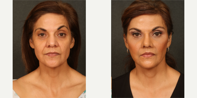 45-54 year old woman treated with Neck Lift, Brow Lift, Eyelid Surgery - performed by Dr.Sozer