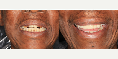 55-64 year old man treated with Full Mouth Reconstruction - Multiple upper teeth missing to a beautiful new smile