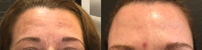 35-44 year old woman treated with SkinPen - SkinPen Microneedling with platelet rich plasma was used to promote collagen production and reduce acne scarring. This photo was only after 2 treatments. 3 treatments are being performed total. This was just using SkinPen with PRP only.