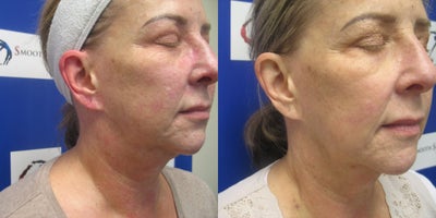 65-74 year old woman treated with Microneedling RF - Before and after 3 Sylfirm X RF microneedling treatments. History of rosacea , hyperpigmentation and scarring. Sessions over 3 months. Topical exosomes were also used. JB
