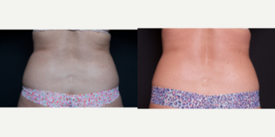 45-54 year old woman treated with SculpSure to abdomen and lovehandles - 35-44 year old woman receives a total of 2 SculpSure treatments to abdomen and 1 treatment to love handles, performed at 12 week intervals.