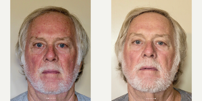 55-64 year old man treated with CO2 Laser - With the CO2RE laser skin resurfacing treatment, patients experience improvement in: Skin tone and textureSun-damaged skin .Age spots .Fine lines and wrinkles .Facial scars