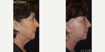 Woman treated with Facelift, Neck Lift - This patient underwent a Face/Neck Lift, She wanted a more lifted & Refreshed look!