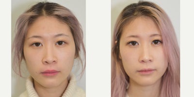 18-24 year old woman treated with Asian Rhinoplasty - Before and after rhinoplasty procedure. Post-operative photos taken at approximately 12 months following surgery.Please note comments have been tuned off for all clinical before/after images as per AHPRA guidelines.All surgery performed by Dr Jason Roth (MED0001185485), Otolaryngology head and neck surgeon, Sydney.Results vary from person to person.Cosmetic surgery is a serious decision.Before proceeding, please seek medical advice from an appropriately qualified medical practitioner.