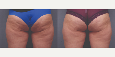 25-34 year old woman treated with Cellfina - 7 weeks after cellfina
