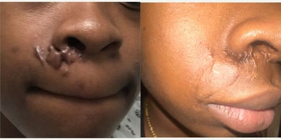 25-34 year old woman treated with Silagen, Scar Removal, Laser Scar Removal, YAG Laser, CO2 Laser, Chemical Peel - A combination of treatments was done to heal, repair, and turn that scar tissue back into normal skin.Keloid and scarring from surgery, the last doctor told her find makeup that would match her skin. I'm no where near done. I will keep treating until it's invisible. Around 6 sessions at 2-3 weeks apart.Still working on reducing the appearance, I would say 3-4 more sessions.