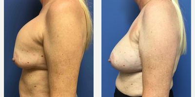 45-54 year old woman treated with Breast Implant Revision - 54 year old woman who developed grade 4 capsules from 29 year old  textured, saline implants. she underwent a bilateral breast implant exchange with complete capsulectomies and upsizing to high profile 385 cc silicone implants