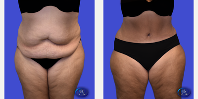 45-54 year old woman treated with Tummy Tuck, Umbilical Hernia Repair - 51-year-old patient 7 months post abdominoplasty and hernia repair