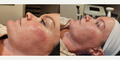 35-44 year old woman treated with IPL, Lumecca - 2 IPL/Lumecca treatments to help with sun damage and broken capillaries.