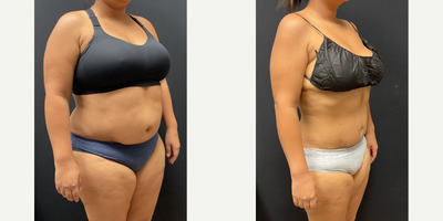 Woman treated with Semaglutide - Woman treated with Semaglutide