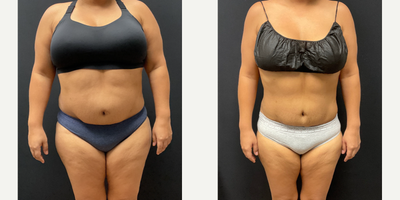 Woman treated with Semaglutide - Woman treated with Semaglutide