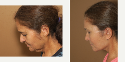 45-54 year old woman treated with Facelift - Complex Facial Rejuvenation: Endobrow, Midface Lift, Face Lift
