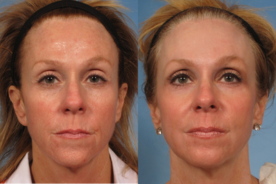 50 year old woman with sun damage who was treated with a Croton Oil/Phenol Peel - 50 year old woman with sun damage who was treated with a Croton Oil/Phenol