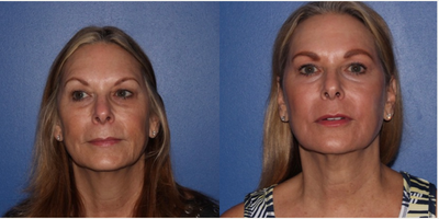 65-74 year old woman treated with Scar Removal, Laser Scar Removal - Sciton Yag laser resurfacing. Addresses hooding of the eyelids, skin discoloration, poor texture, and tightens. Patient was treated with one full face yag laser resurfacing treatment.