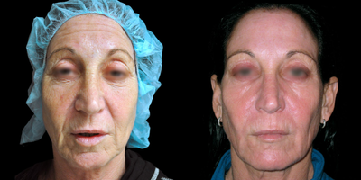 55-64 year old female treated with TotalFX - This patient underwent TotalFX laser resurfacing. The DeepFX laser handpiece was used to treat around the eyes and around the mouth. The ActiveFX laser handpiece was used to treat the entire face.