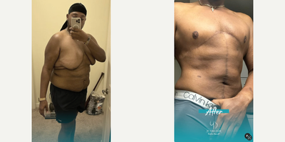 Man treated with Gynecomastia Surgery - Heres some math for you: 365 days after his 360-degree tummy tuck, full tummy tuck, upper back lift, and gynecomastia surgery, this patient has done a 180 to live his best life.