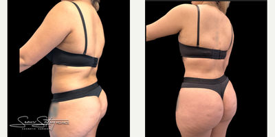 26 year old female treated with VASER Liposuction, Renuvion J Plasma Skin Tightening and post-operative lymphatic massages - 26 year old female who underwent VASER assisted liposculpting and Renuvion J plasma skin tightening of the abdomen, flanks, axilla, upper/middle/lower back; fat grafting to the buttocks and lateral hips (Brazilian Buttock Lift, BBL). Patient underwent 6 post-operative lymphatic massages.