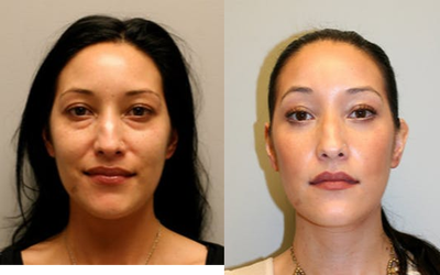 Woman treated with Laser Resurfacing - Woman treated with Laser Resurfacing through CO2 laser. She also had transconjunctival blepharoplasty to improve tired appearance and her eye bags.
