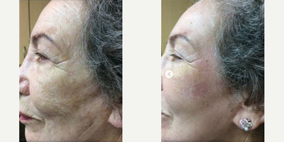 Woman treated with Fraxel Laser - This patient is only 9 days post treatment and still peeling but her results are amazing and will only get better with time
