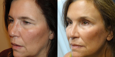 55-64 year old woman treated with Forehead Lift - Treated with Bilateral Endoscopic Forehead Lift.