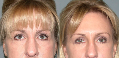 45-54 year old woman treated with Brow Lift - This 50 year old woman wanted to rejuvenate her forehead and upper eyelids. She had an endoscopic brow lift with small incisions hidden in the hair, as well as an upper eyelid lift using a CO2 laser. Her results are shown 6 months later.