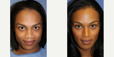 Woman treated with Facial Feminization Surgery - Woman treated with Facial Feminization Surgery through chin reduction (genioplasty)