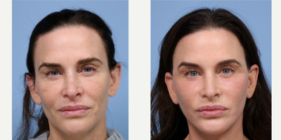 55-64 year old woman treated with Facelift Revision - This gorgeous patient came to us for a revision face and neck lift. She had a lift with a different surgeon a few years back and was unsettled with the final result. Drs. L&P gave her the refreshed appearance she had been dreaming of. This patient was beautiful beforehand, but she still had some concerns with skin tightening. It has been a true pleasure to have this patient in our care and we are thrilled every time her vibrant energy is around the office.