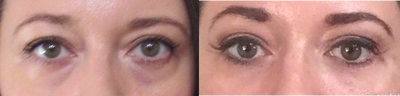 25-34 year old woman treated with Restylane Silk - Restylane silk with cannula to the under eye (tear troughs) volume and Voluma to the cheeks for lifting and contouring.