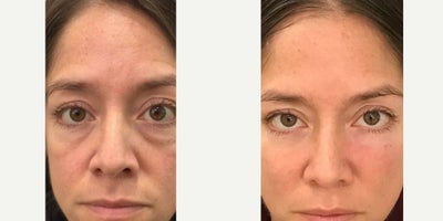 35-44 year old woman treated with PRP Injections, Skin Rejuvenation, Dermal Fillers, Microneedling - Treated by Aubrey H. and Alyss G