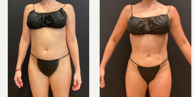 35-44 year old woman treated with Brazilian Butt Lift, Rib Removal, Abdominal Etching - Rib Repositioning, BBL, and HD Lipo by Dr. Franco