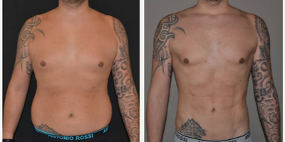 Man treated with Power-Assisted Liposuction (PAL) - One of the many advantages of PAL-HD is the control of the level of definition that we can give to our patients. This patient requested mild definition, and guess what, thats what he got.