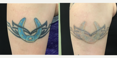 35-44 year old woman treated with Tattoo Removal, PicoSure - Before & After only 3 Sessions of Tattoo Removal using the PicoSure laser. This client didn't want complete removal because they are getting a cover-up tattoo, so our goal was to lighten the tattoos. After just 3 sessions there was significant reduction in the tattoo ink and she is excited to get her new tattoos.
