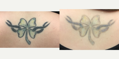 35-44 year old woman treated with Tattoo Removal, PicoSure - Before & After only 3 Sessions of Tattoo Removal using the PicoSure laser. This client didn't want complete removal because they are getting a cover-up tattoo, so our goal was to lighten the tattoos. After just 3 sessions there was significant reduction in the tattoo ink and she is excited to get her new tattoos.