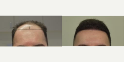 25-34 year old man treated with PRP for Hair Loss, Hair Transplant, FUE Hair Transplant, Exo-Xom - PRP for Hair Loss - Hair Transplant - FUE Hair Transplant - Exo-xomEarly 30s,he is currently 6 months out at only 50% of his results at the moment.