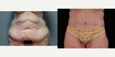 65-74 year old woman treated with Body Lift - 62 years old, 5'5, Max weight was 305lbs, was 190lb pre-surgery, now 166lb.