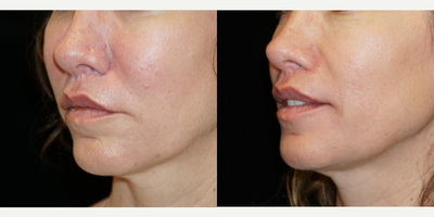 35-44 year old woman treated with Lip Repositioning - This beautiful patient was interested in a revision lip lift after her original procedure addressed her mid upper lip, but did not lift the lateral upper lip. A lift of the lateral upper lip is one of the most difficult areas to address in a lip lift. I performed a modified upper lip lift to address the lateral areas and improve her tooth show at rest. Here she 3 months post procedure.