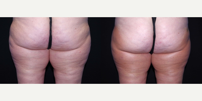 45-54 year old woman treated with Cellulaze - 45 year old female received Cellulaze to the outer thighs; photos depict the patient's results 11 weeks post-op.