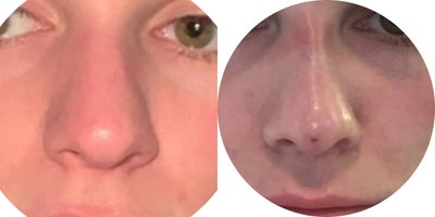 18-24 year old woman treated with Thread Lift, Contour Thread Lift - This 24-year-old patient desired a slimmer nasal profile with improved tip projection while avoiding surgical rhinoplasty. A non-surgical nose enhancement was performed using threads to refine the dorsum and subtly elevate the tip. Immediate post-procedure results demonstrate improved contour, better definition, and a more balanced profile. The outcome maintains natural proportions while enhancing structural support.