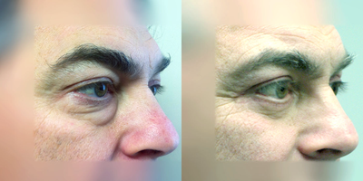 45-54 year old man treated with Eyelid Surgery - Upper and Lower eyelid lift (quad-lid blepharoplasty). Eye bags are one of the first signs of aging, making an eyelid lift one of the first procedures people interested in facial rejuvenation seek.