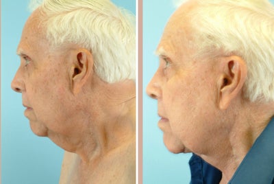 78 Year Old Male Treated for Neck Skin Laxity - 
	78 Year Old Male Diagnosis: Laxity of the Skin of the Neck Procedure: Necklift
