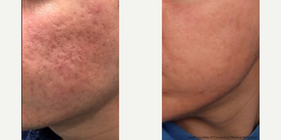 Woman treated with CoolPeel, Skin Rejuvenation - Woman treated with CoolPeel, Skin Rejuvenation