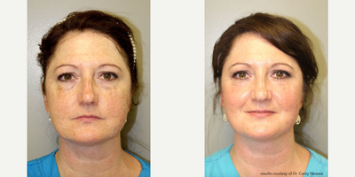 Woman treated with CoolPeel, Skin Rejuvenation - Woman treated with CoolPeel, Skin Rejuvenation