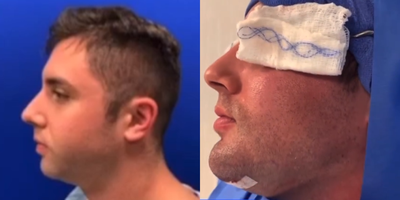 Woman treated with Chin Implant - Woman treated with Chin Implant