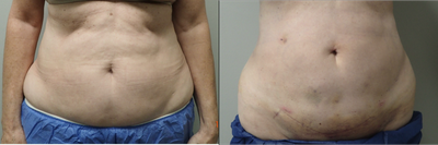 55-64 year old woman treated with Smart Lipo - Patient underwent Smartlipo procedure to treat her abdomen and waist areas. The after photo is just 5 days postop. NOTE: the lower abdominal wall scar seen in the after photo is an old scar, it was just covered in the before photo.