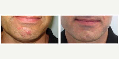 45-54 year old man treated with Pulsed Dye Laser - 45-54 year old man treated with Pulsed Dye Laser