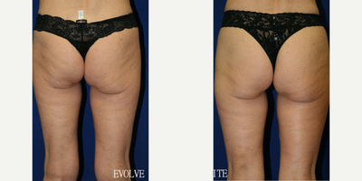 Woman treated with Evolve - Woman treated with Evolve