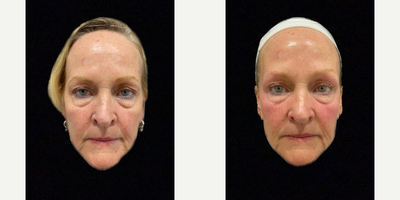 Woman treated with TempSure Envi - Woman treated with TempSure Envi
