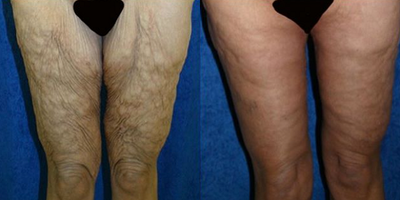 55-64 year old woman treated with Thigh Lift - Dr. Katzen performed his signature 360 circumferential lower body lift, thigh liposuction, and bilateral medial vertical thigh lift. This is a 56 year-old female who weighed 315lbs. at her heaviest. This patient underwent a RNY gastric bypass and lost 160lbs. After her weight loss, she did not like her sagging, wrinkled buttocks or her inner loose and wrinkled thighs. Dr. Katzen combined these procedures. During the 360 circumferential lower body lift, an incision was made at the top of the buttocks and extended to the lower abdomen. During the back part of the 360 circumferential lower body lift, the buttocks were raised and the buttock wrinkles were eliminated. During the front part of the 360 circumferential lower body lift, the rectus abdominis muscles or 6-pack muscles were sewn together and the stomach was flattened. The excess skin and fat of the abdomen, hips, and buttocks was removed. During the lower body lift, Dr. Katzen also performed a bilateral medial vertical thigh lift. During the thigh lift, thigh liposuction was performed. Then, an incision was made from the groin to the inner knee on the inside of the thigh. Two large elliptical areas of skin and fat were removed from the inner thighs and the thighs were tightened. During the 360 circumferential lower body lift, 360 thigh liposuction, and bilateral medial vertical medial thigh lift, Dr. Katzen removed 16lbs. Please note her new, wrinkle-free buttocks. Also, look at her thighs!!! NO more thigh skin wrinkles and a thigh gap.